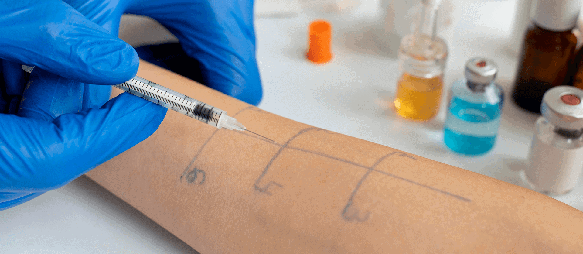 skin allergy reaction test person s arm 1 1