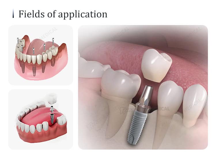 titanium dental implant fixture detail image 2