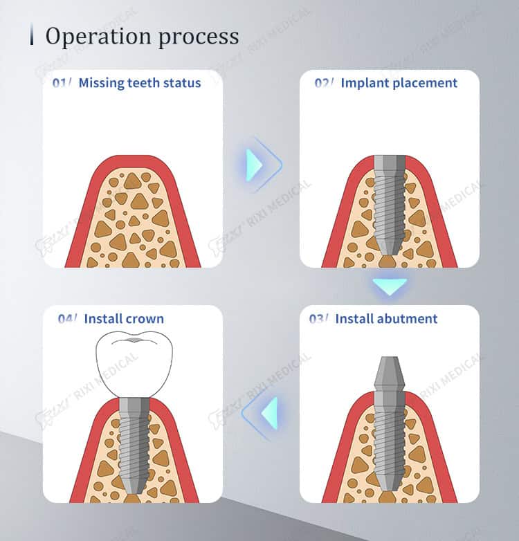titanium dental implant fixture detail image 3
