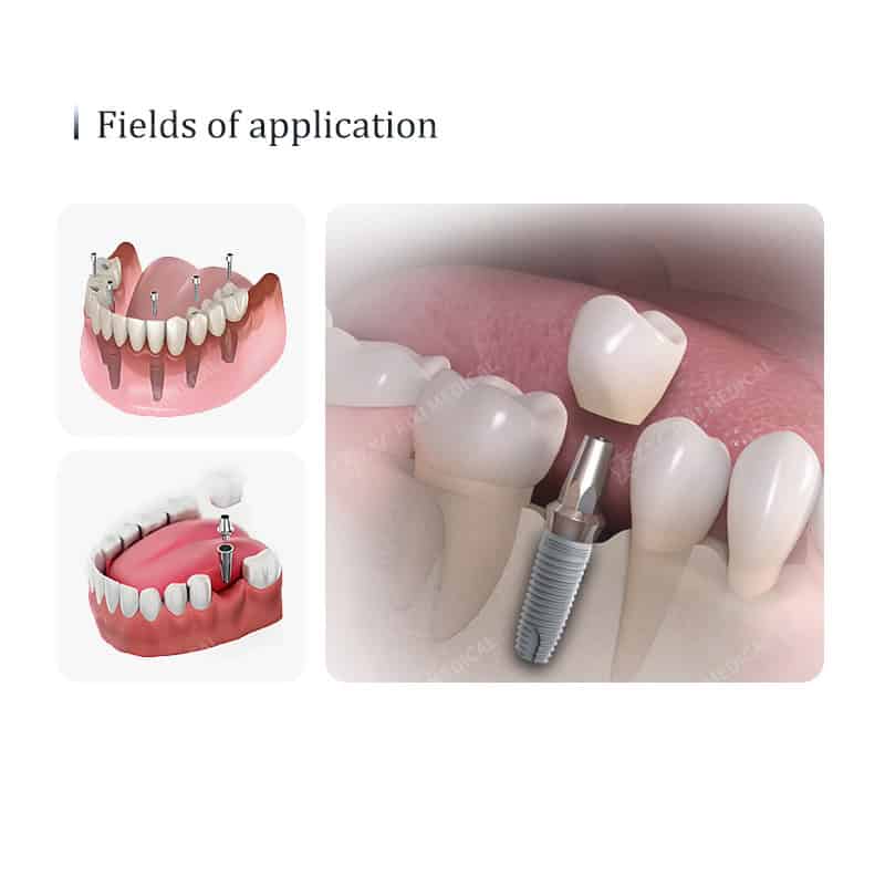 Titanium Dental Implant Fixture with Threaded Root Form main image 5