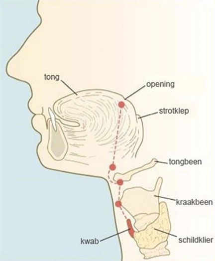 Aanlegstoornis