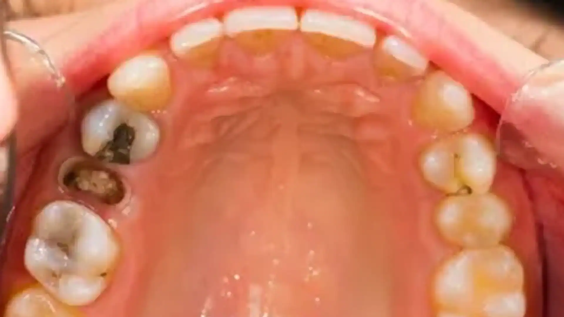 Tooth Extraction In Dubai | Painless, Safe Dental Procedure