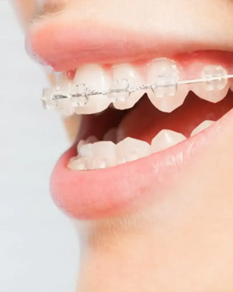 Ceramic Braces Dubai | Straighter Smile With Confidence