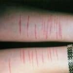 Teen self-harm awareness and support - adolescent therapy in Sarasota and Venice FL