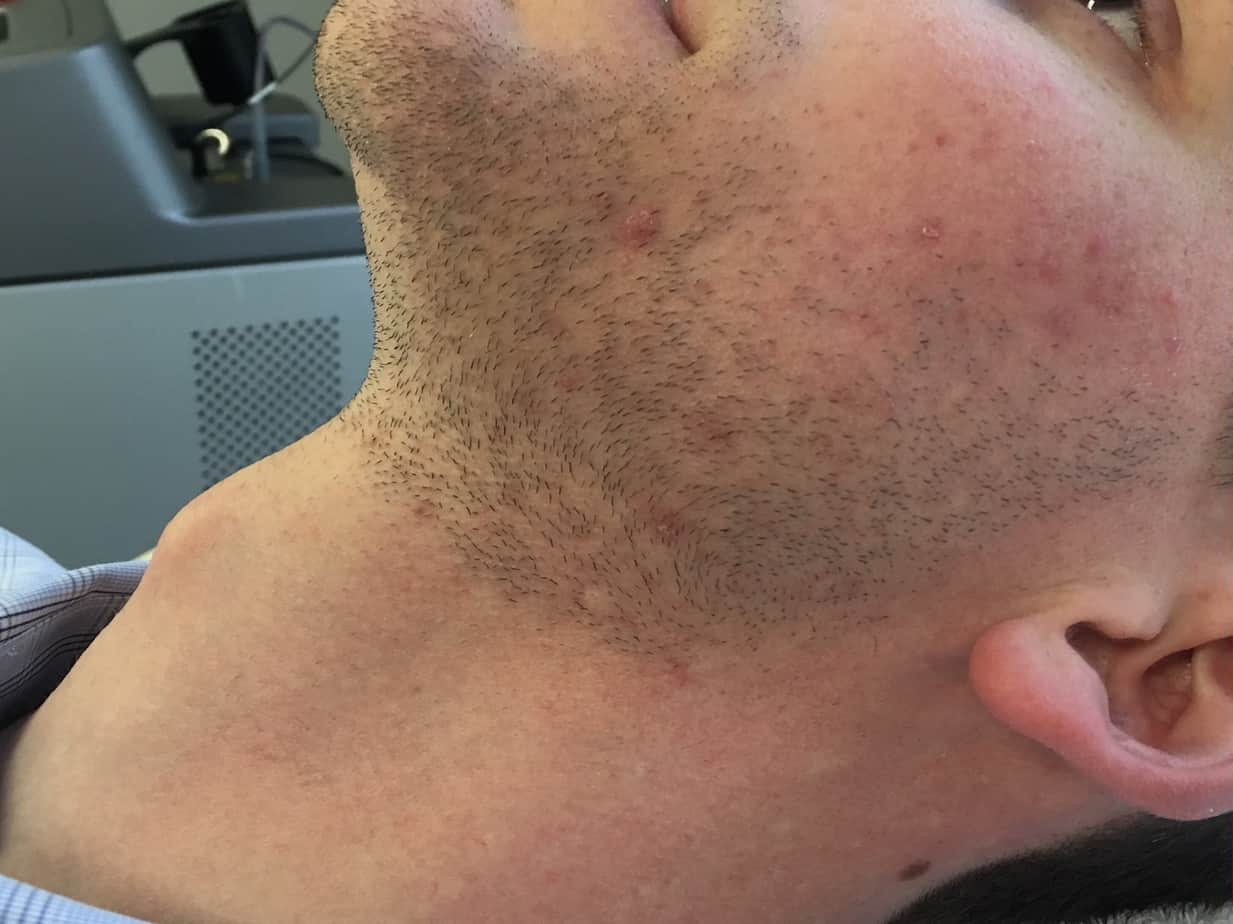 close up of man's neck after laser hair removal with no hair or blemishes