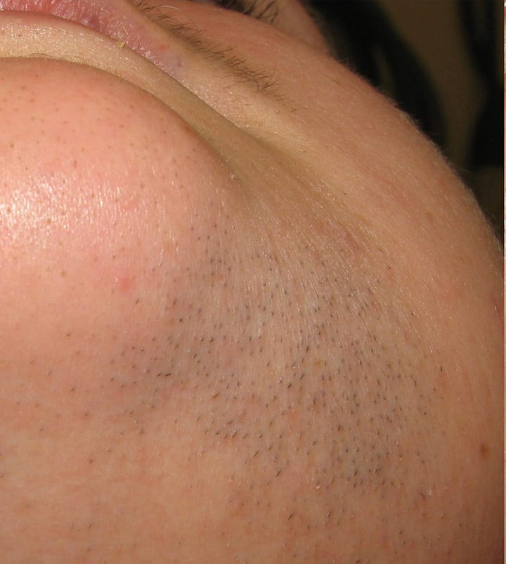 close up of chin with stubble before laser hair removal treatment