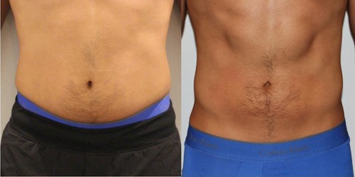 before and after showing more fit male abdomen after body sculpting