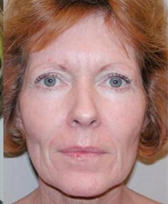 TCA peel after woman's face looking more youthful after TCA peel