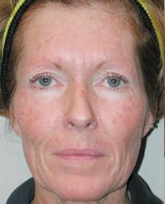 TCA peel before woman's face with photodamaged skin