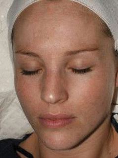 jessner-peel-after woman with beautiful skin after Jessner peel