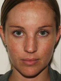 jessner-peel-before woman with excess pigment on her facial skin