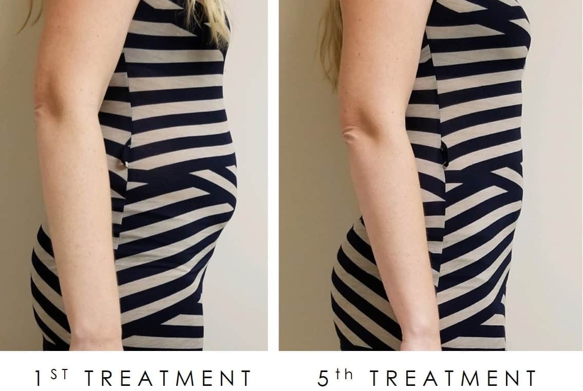 cryoskin coolsculpting before and after