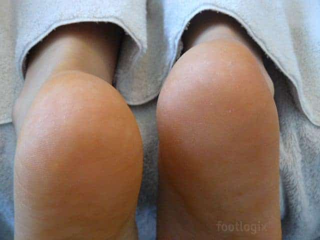 Heel care for very dry, cracked skin with Footlogix formula.