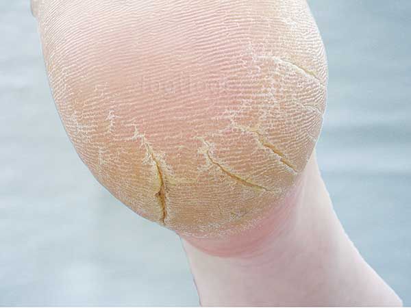 Close-up of cracked heel skin showing dryness and fissures.