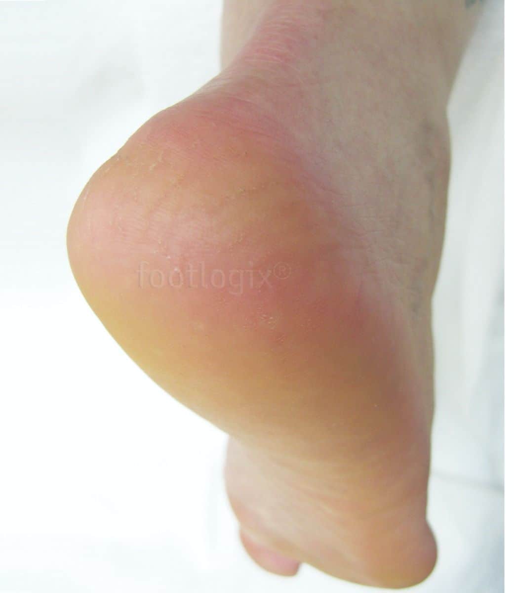 Footlogix rough skin foot treatment for dry, cracked heels.