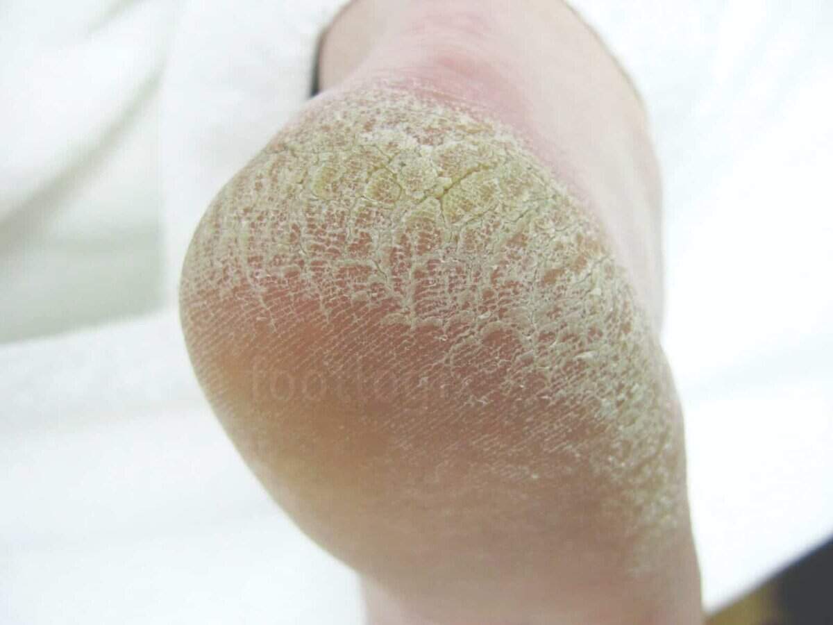 Footlogix rough skin foot treatment for dry, cracked heels. Ideal for nourishing and softening thick.