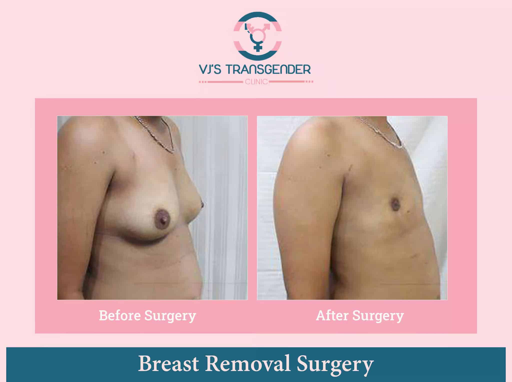 Breast removal surgery before and after photos at VJ Transgender Clinics.