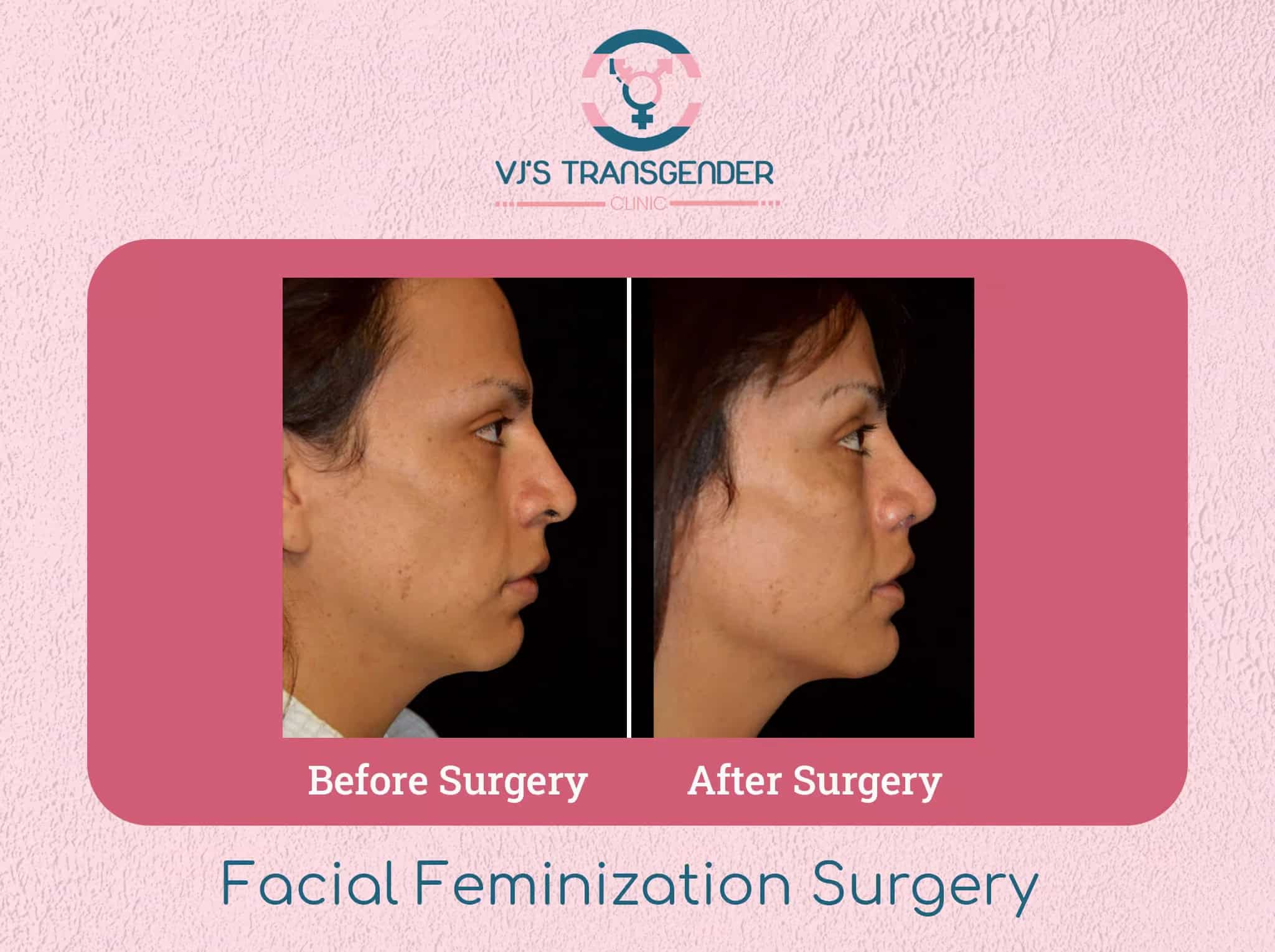 Natural transgender facial feminization surgery before and after transformation.