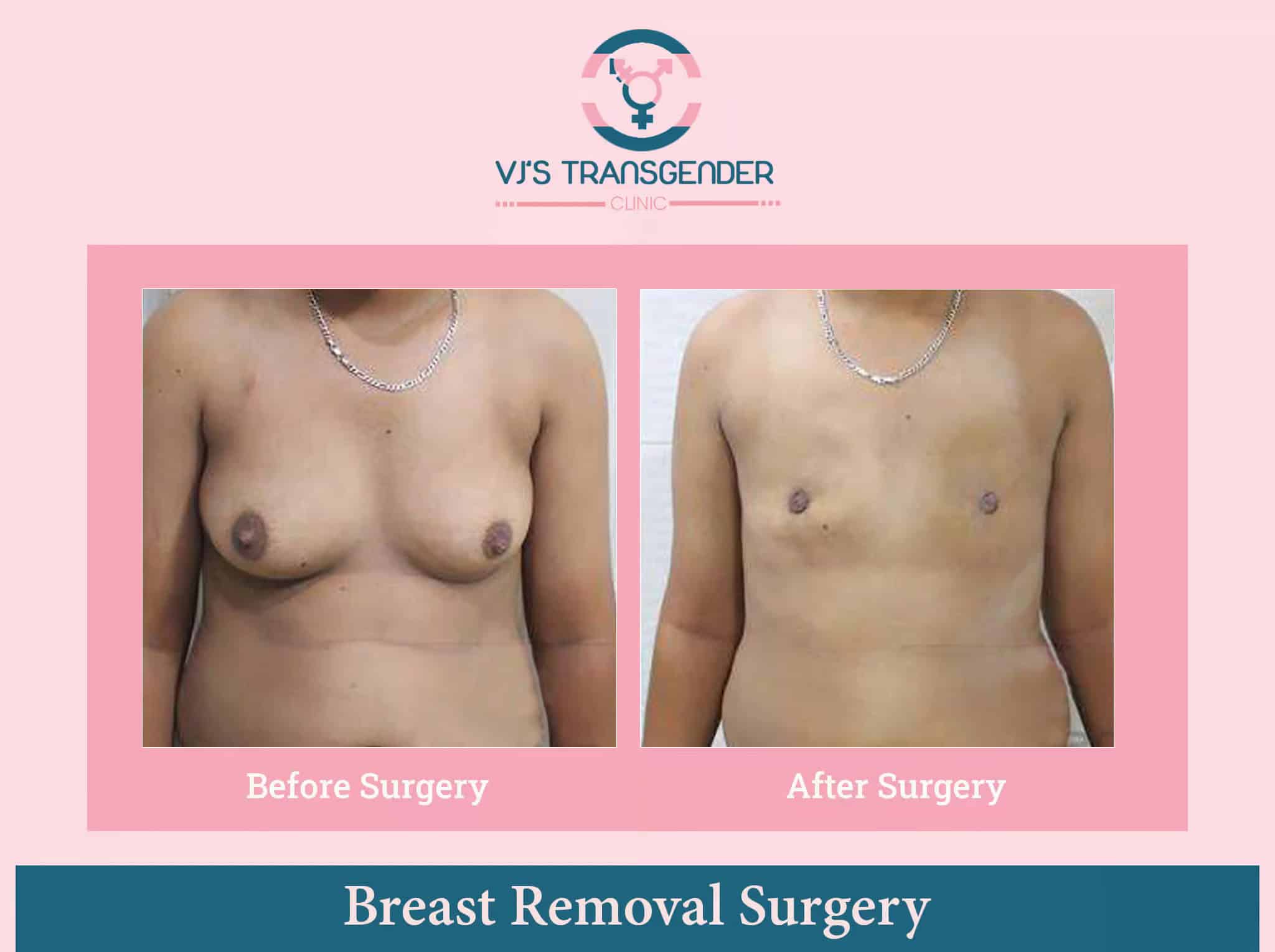 Breast removal surgery for transgender men, top surgery, chest reconstruction, VJ Transgender Clinics.