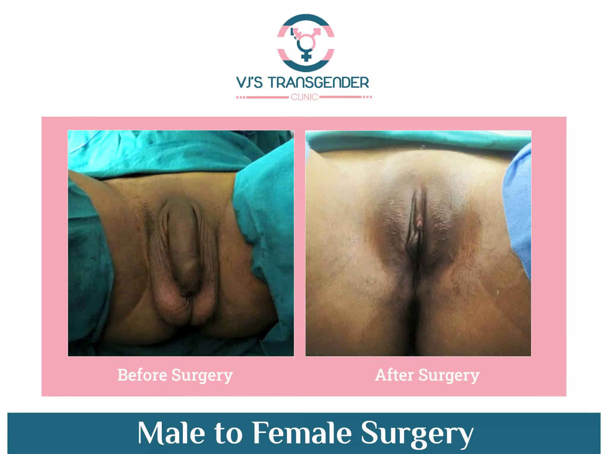 Transgender gender confirmation surgery, male to female transition, VJ Transgender Clinics.