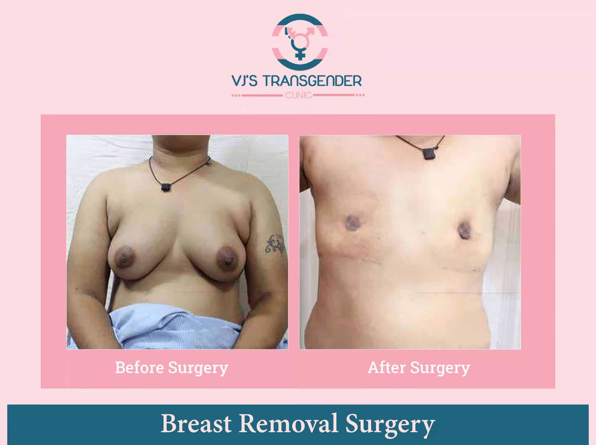 Breast removal surgery before and after photos on VJ Transgender Clinics website.