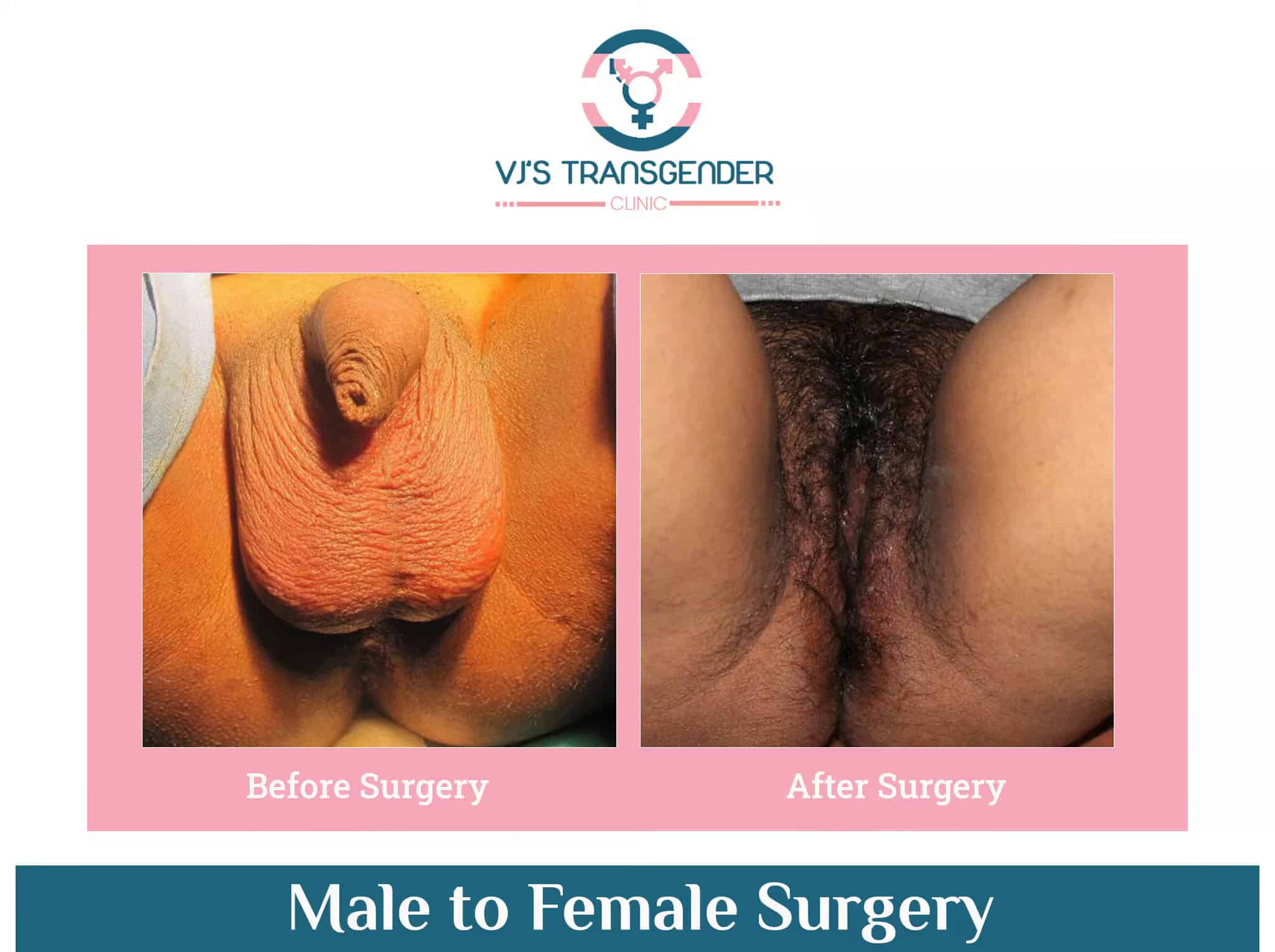 Genital reconstruction surgery for male-to-female transgender transition at VJ Transgender Clinics.