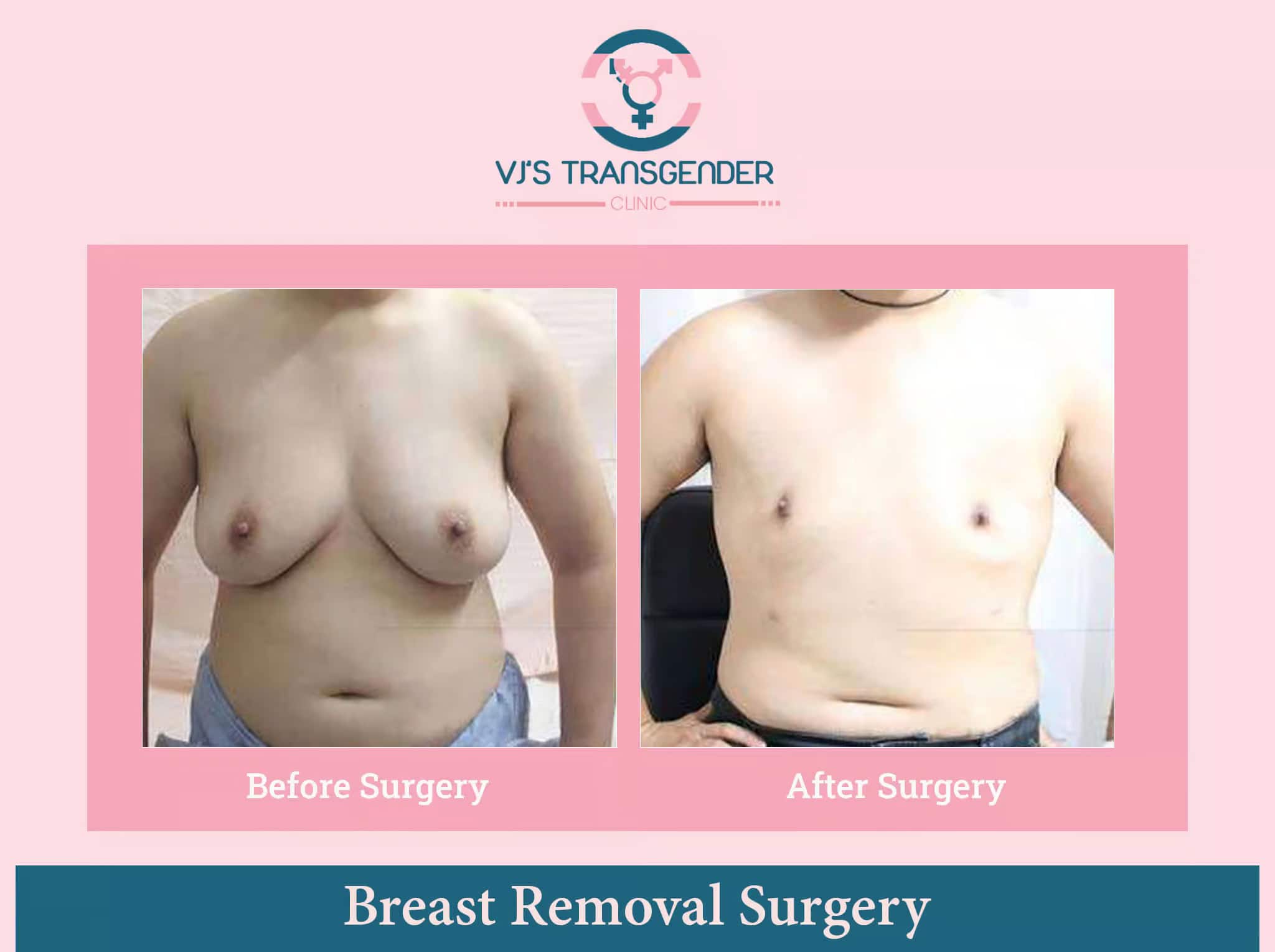 Scar and before-after breast removal surgery photos at VJ Transgender Clinics.