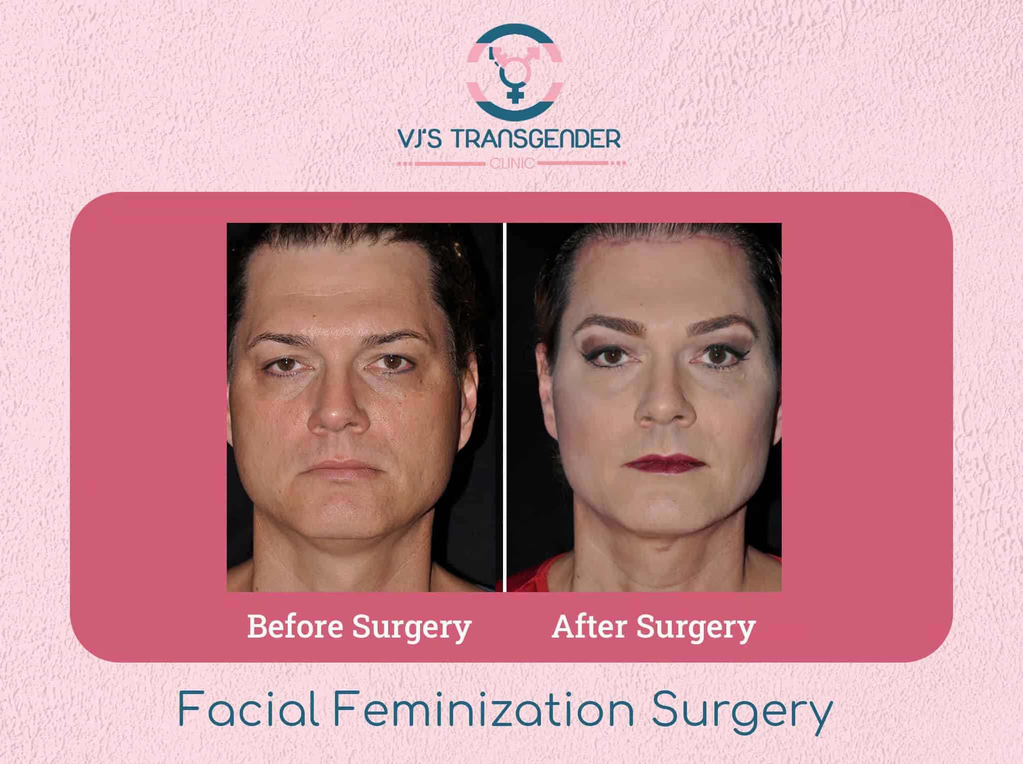 - Transgender facial feminization surgery before and after photos, transgender healthcare images.