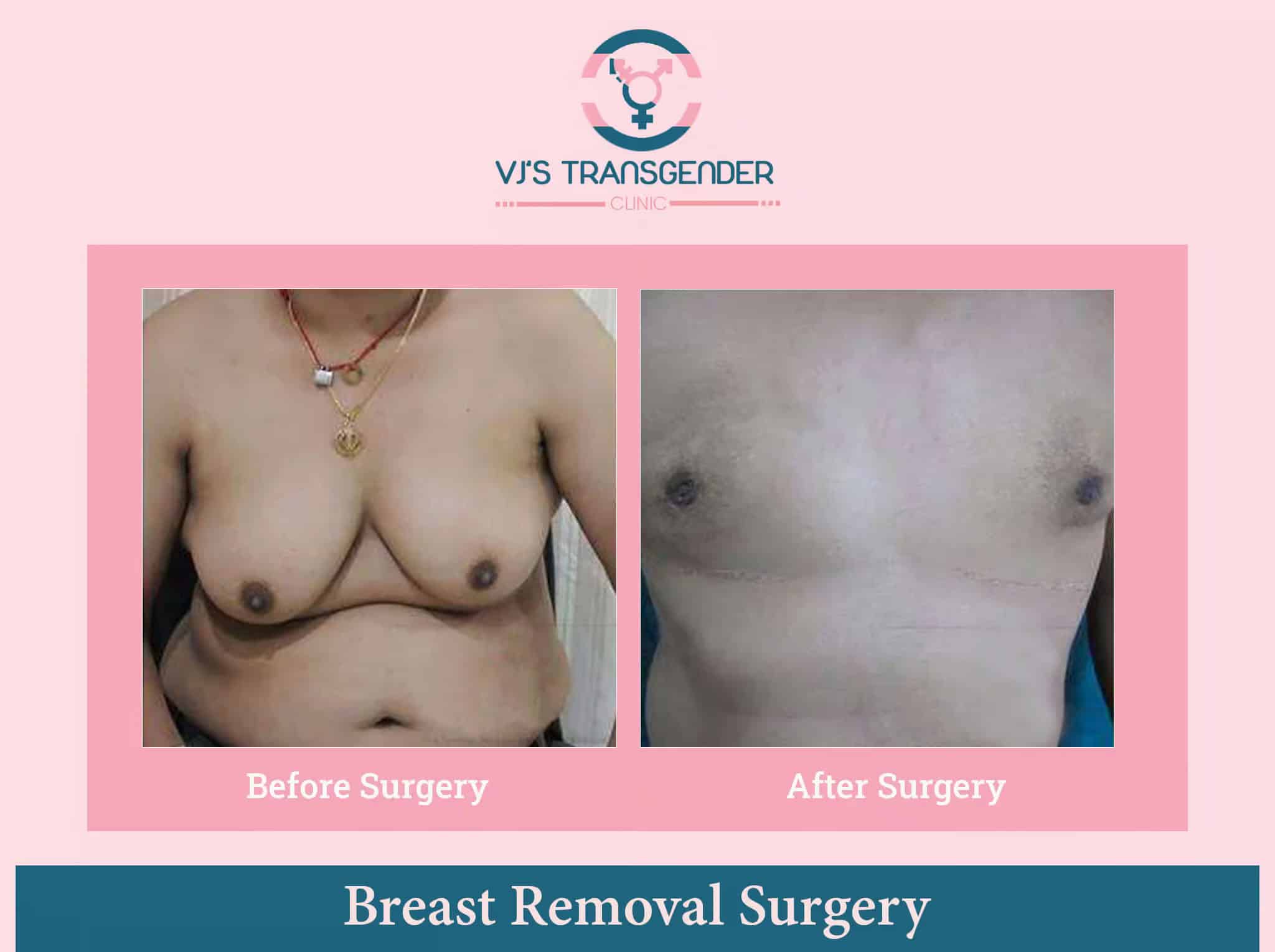 Breast removal surgery for transgender individuals before and after transformation.