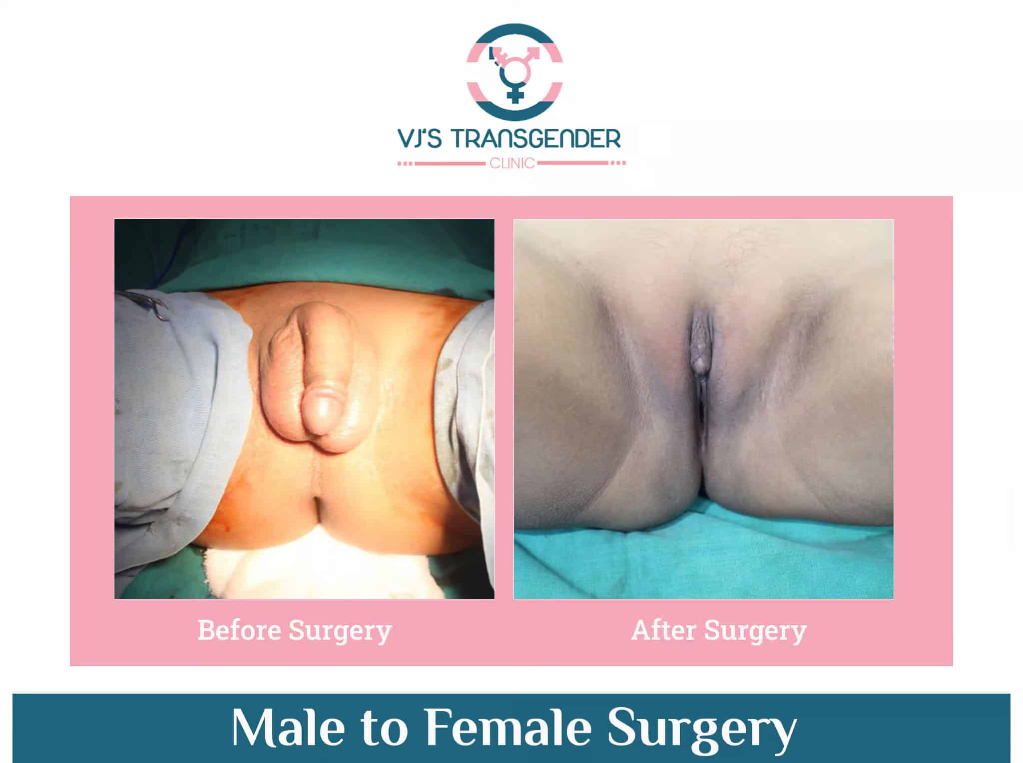 Female genital surgery transformation after gender confirmation procedure for transgender patients.