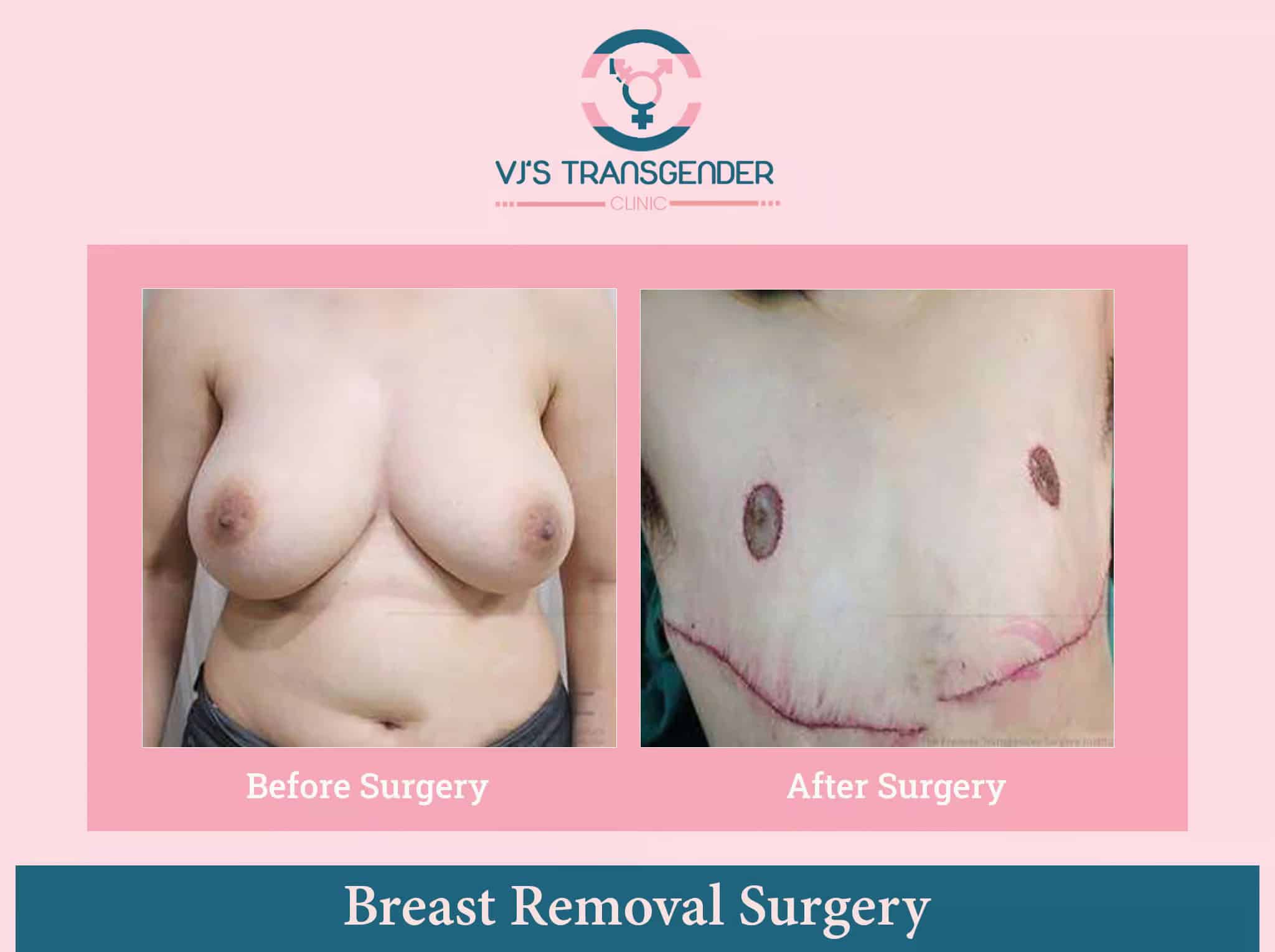 Breast removal surgery before and after images at VJ Transgender Clinics, highlighting transgender and gender affirmation procedures.