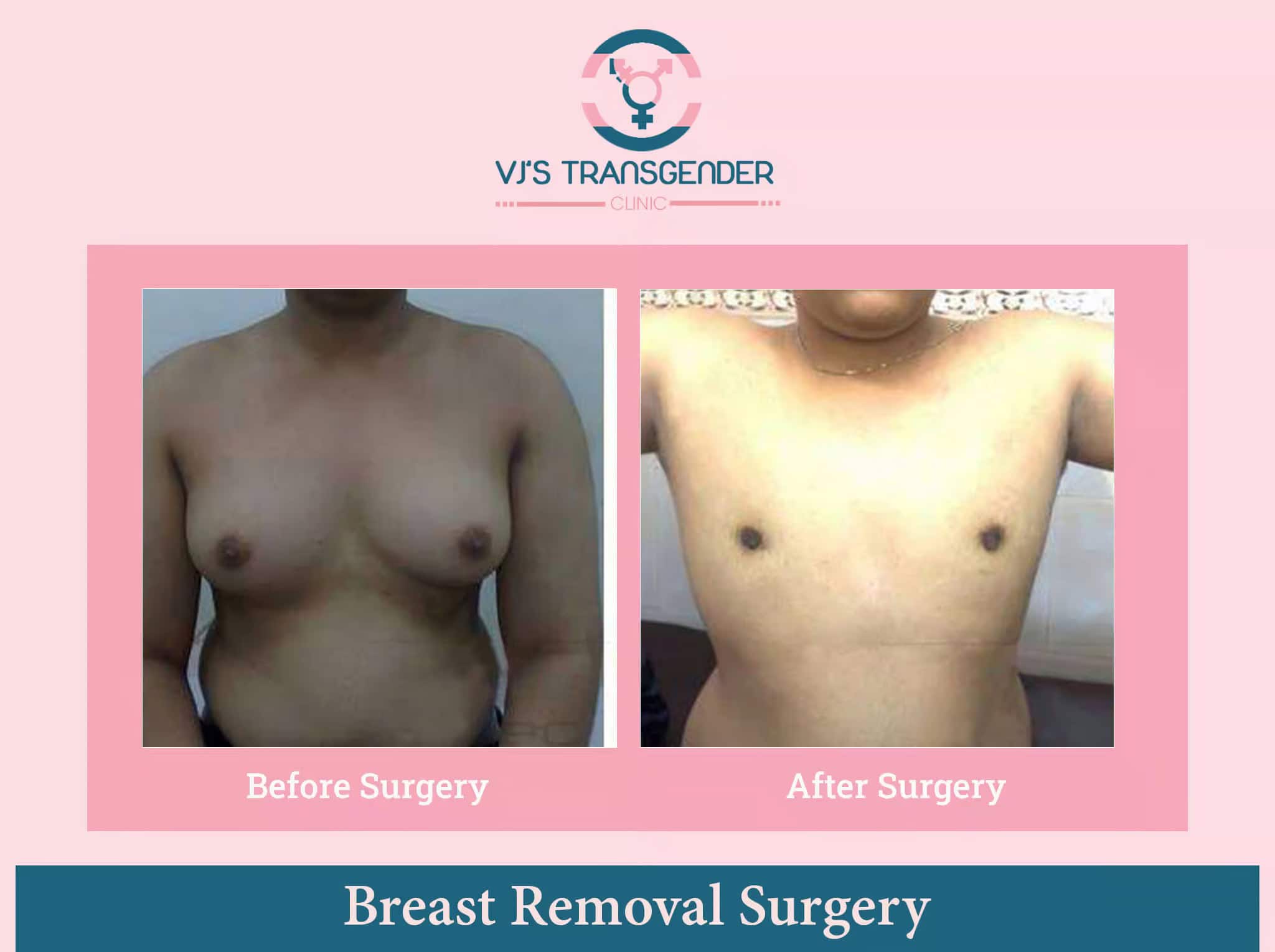 Effective transgender healthcare breast surgery transformation before and after results.