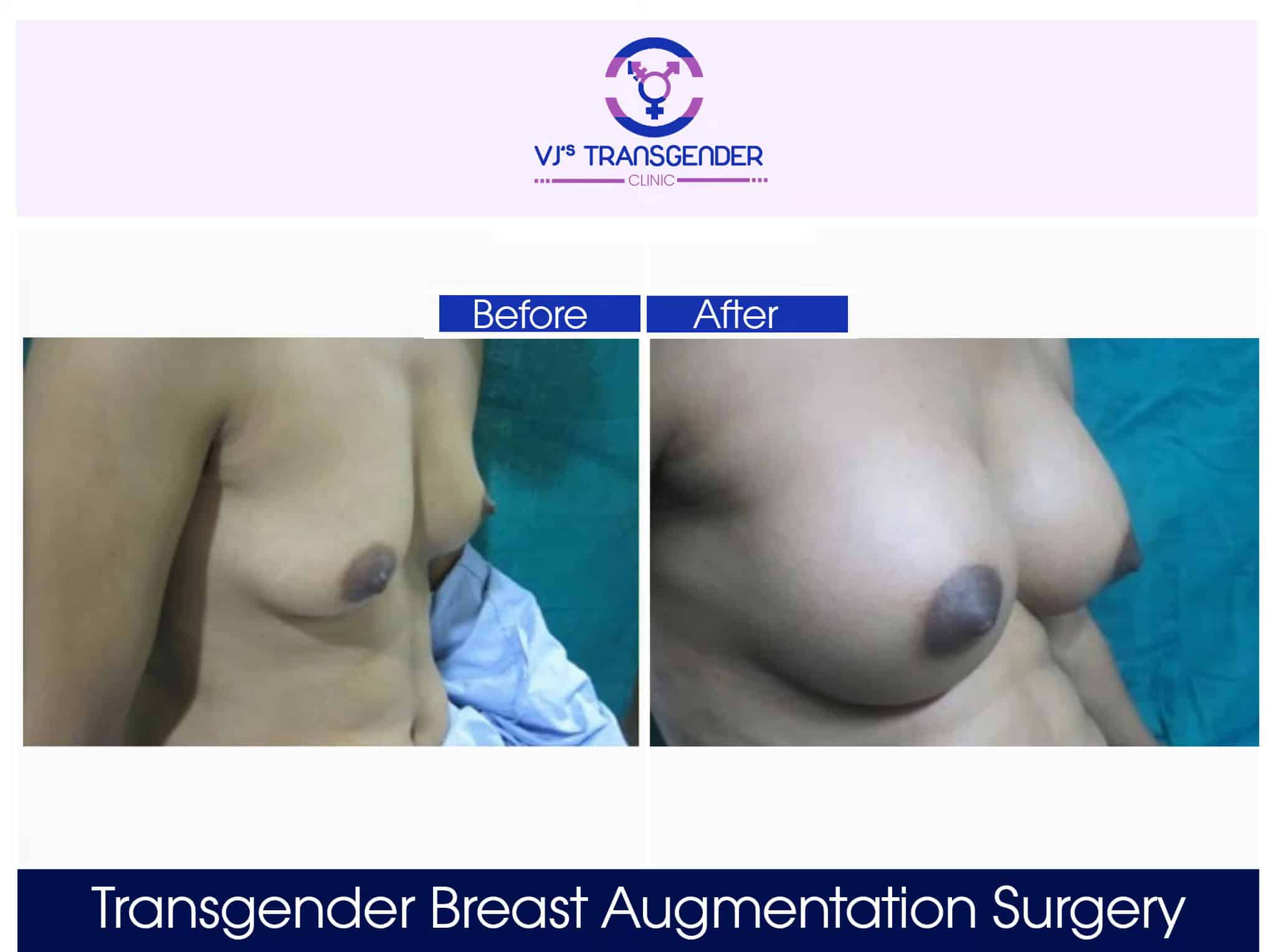 Natural transgender breast augmentation surgery before and after images.