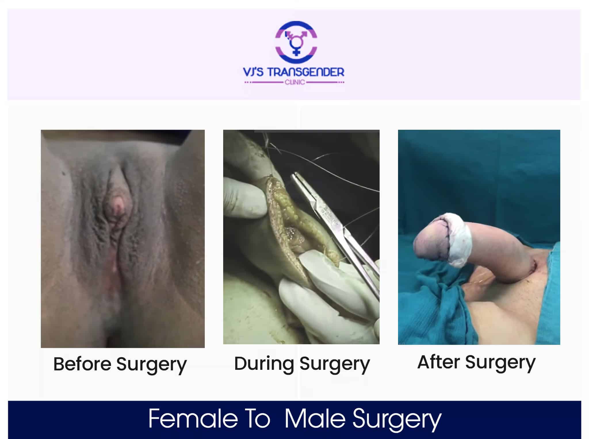 Genital gender affirmation surgery process VJ Transgender Clinics.