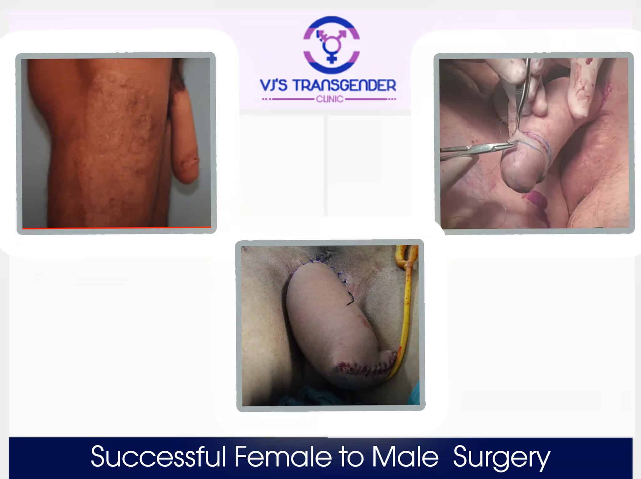 VJ Transgender Clinic - Female to Male Gender Confirmation Surgery Process.