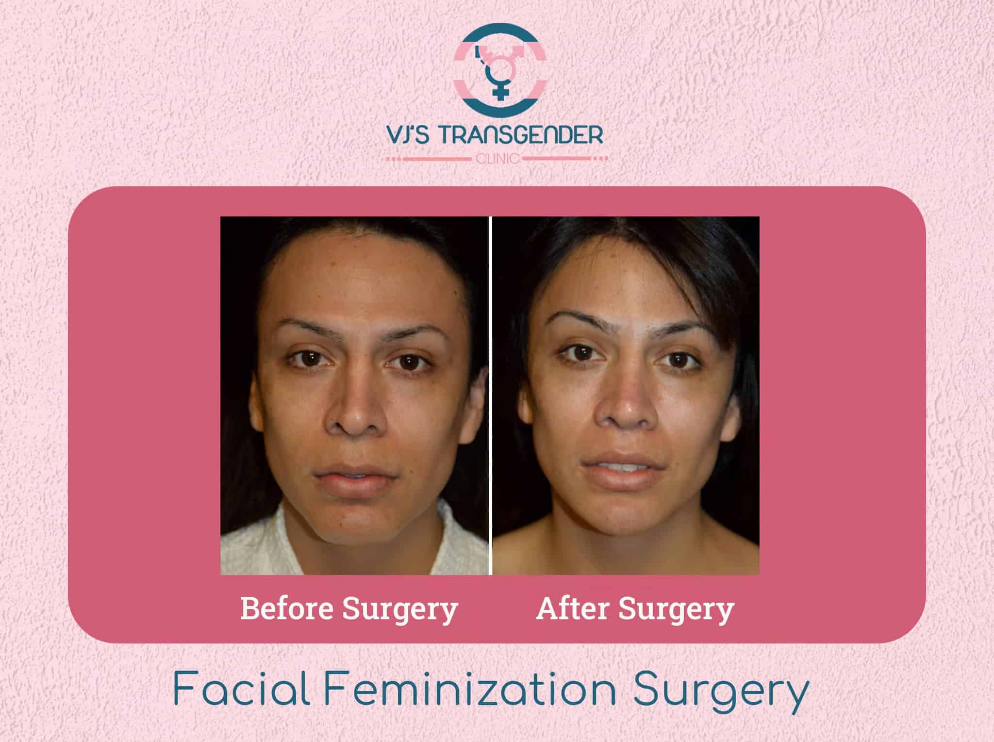 Male to female gender transition before and after facial feminization surgery images.