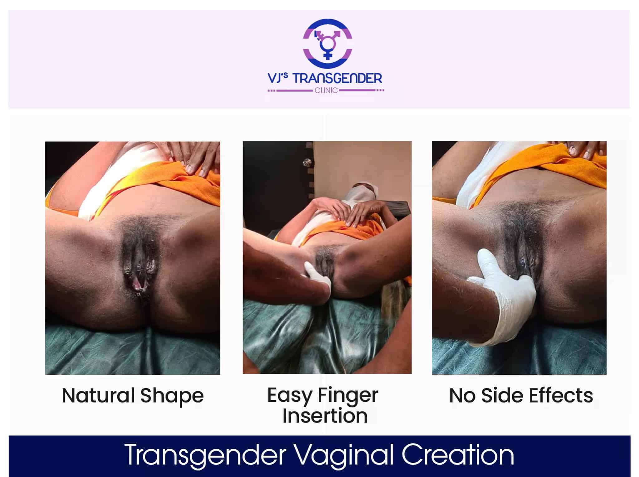 VJ Transgender Clinics professional transgender vaginal creation services for trans women.