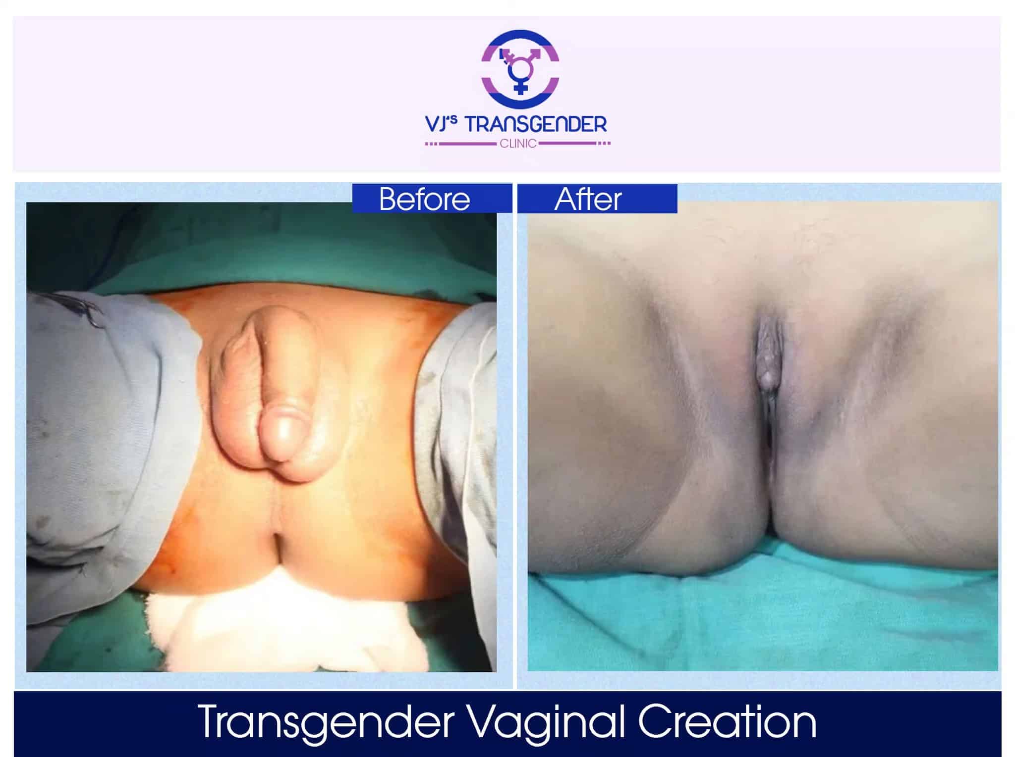 Vj transgender clinics transgender vaginal creation before after photos.