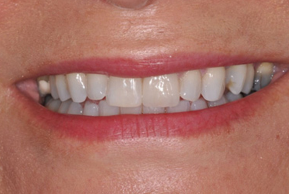 Close-up of a brightened smile after professional teeth whitening