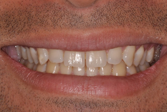 Custom whitening trays fitted to a patient's teeth