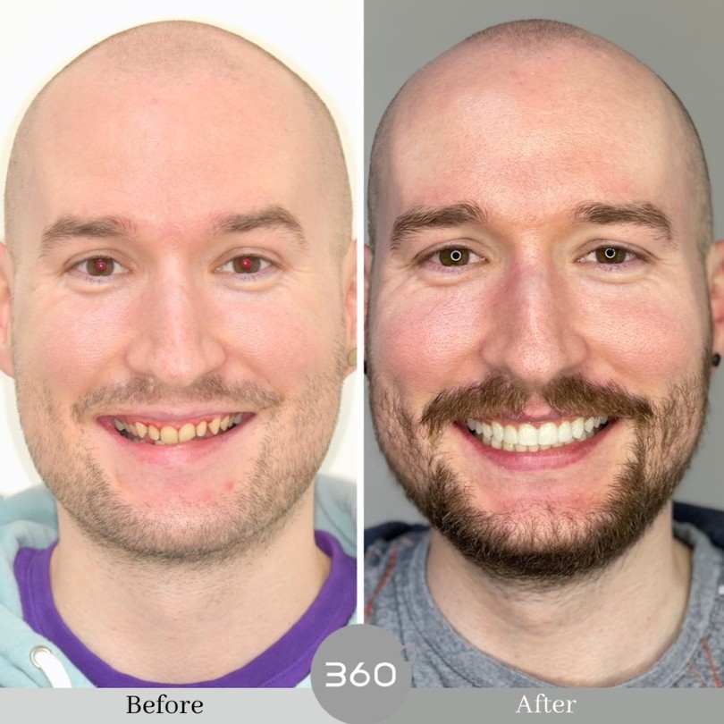 Patient smile after whitening and composite bonding combination treatment