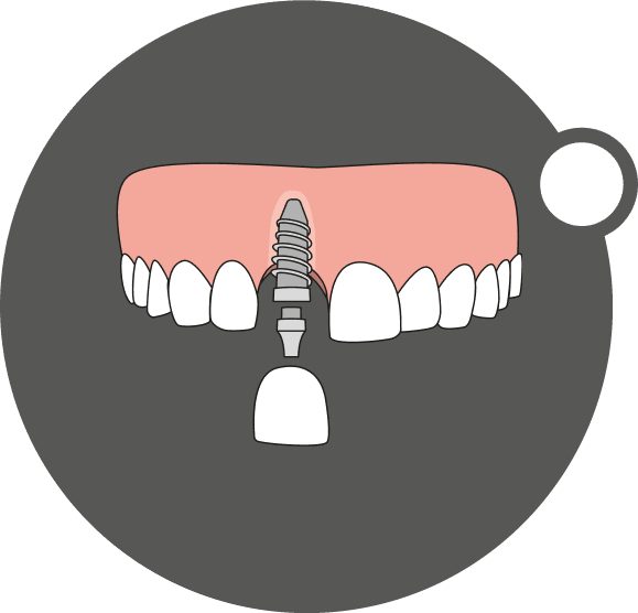 Diagram of a single tooth replaced with a dental implant