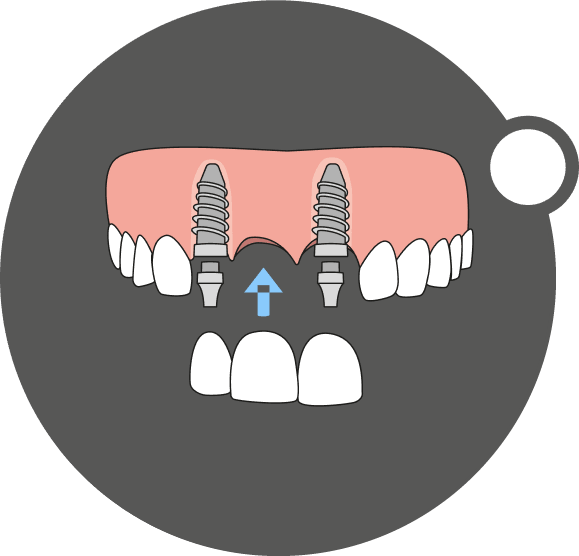 Diagram of multiple teeth replaced with implant-supported bridge