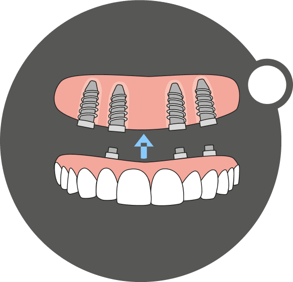Diagram of a full arch of teeth replaced using implant-supported solutions