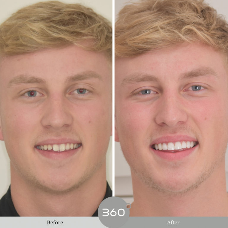 Before and after : 