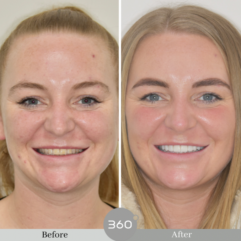 Before and after : 