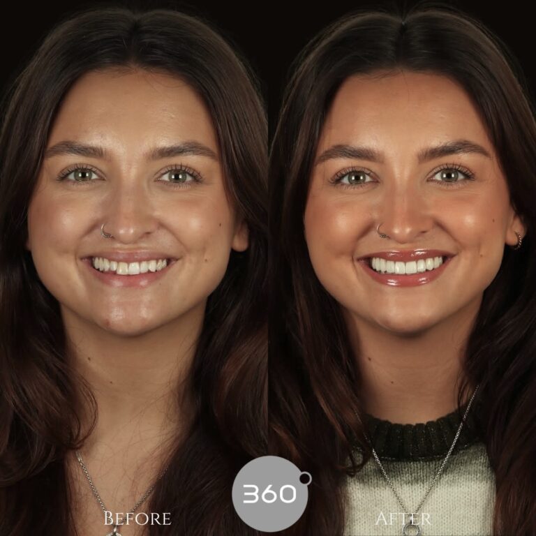 Before and after : 