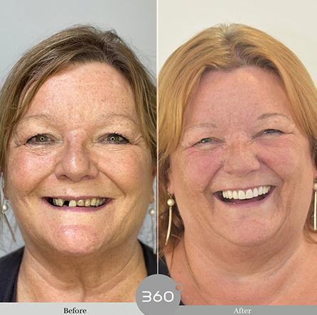 Before and after : 