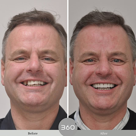Before and after : 