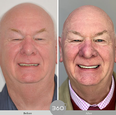 Before and after : 